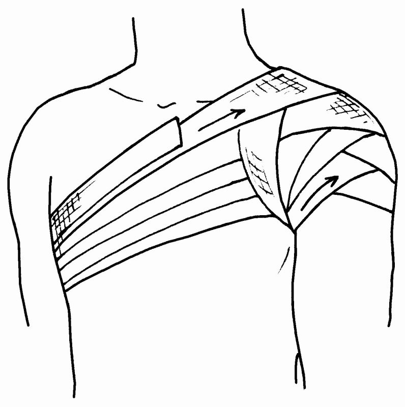 Колосовидная повязка на плечо
