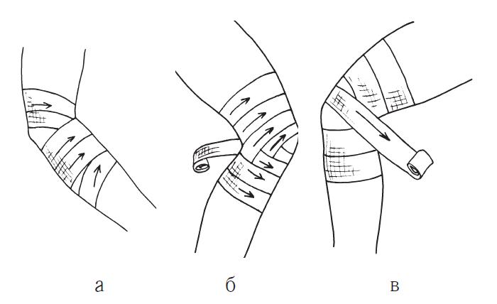 Забинтовать колено эластичным. Колосовидная повязка на плечевой сустав алгоритм. Колосовидная повязка алгоритм. Черепашья сходящаяся на локтевой сустав повязка. Наложение черепашьей повязки на локтевой сустав.
